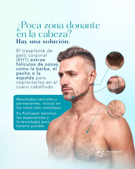Tener poca zona donante en la cabeza ya no es un límite para el trasplante capilar.

El trasplante d