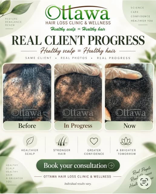 Real progress takes time.

This is a real client’s six-month hair restoration journey.

We are not a
