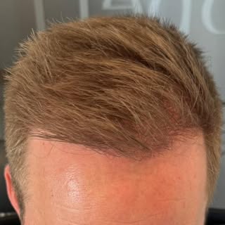2200 grafts. 14 maanden. Groot verschil.

Een volle, natuurlijke look die perfect aansluit bij het g