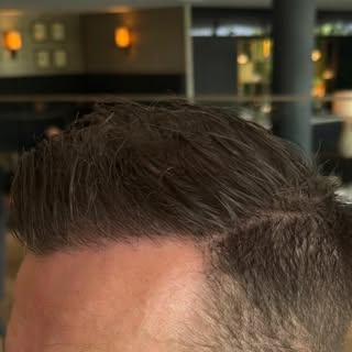 Resultaten die voor zich spreken.

14 maanden na een FUE-haartransplantatie met 2200 grafts.

Een dr
