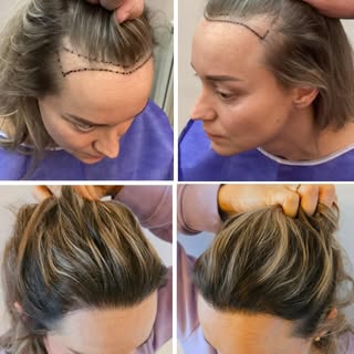 Haartransplantaties zijn er niet alleen voor mannen.

14 maanden na een FUE-haartransplantatie met 2