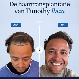 Van Ibiza naar een vollere haarlijn ☀️🌴
@timothy_ibiza 

Timothy Ibiza, koos bij Laser Aesthetic vo