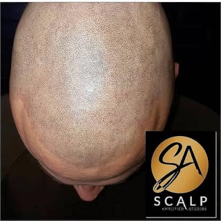 Who said you can't have your hairline back ??? 🤔
The future is here... modern way for making you lo
