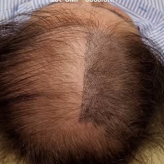 SMP is also for women !  Anyone who experiences hair thinning or even not enough density after hair 