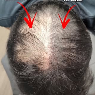 Want something more permanent than HAIR FIBERS ?
SMP (Scalp Micropigmentation) will create the illus