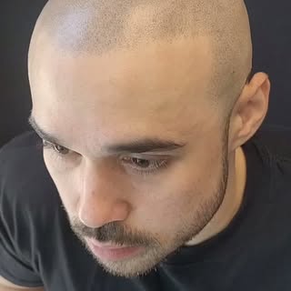 JUST  IMAGINE .... GETTING YOUR HAIRLINE BACK !!!
More confidence,  looking younger,  better ! 
It c