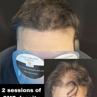 SMP is also for THINNING HAIR 😎

You don't have to wait for bald spots and recession.  SMP (Scalp M