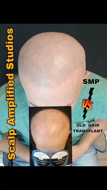 The difference between  SMP vs  HAIR TRANSPLANT 
SMP
  fuller density ✅️
 full top coverage (not jus