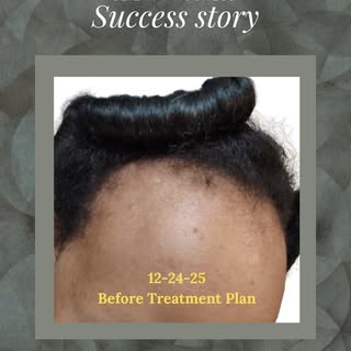 This client did wonderfully following her plan and is so happy to have her front hairline coming bac