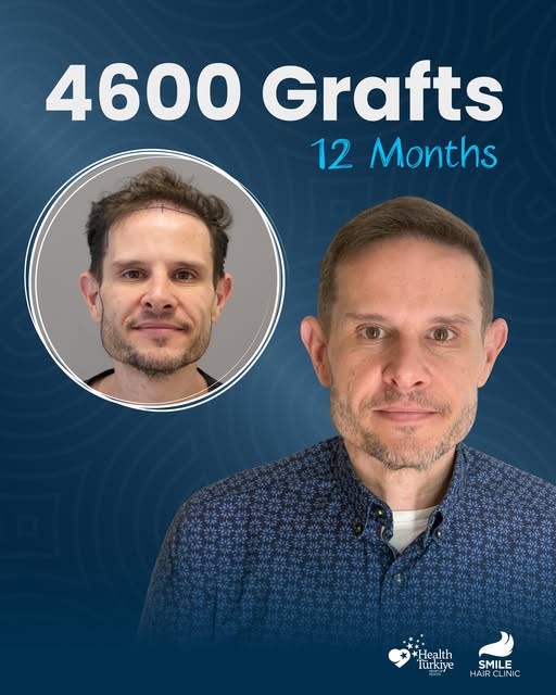 12 months. One remarkable transformation. ✨

Swipe to see our patient’s hair transplant before and a