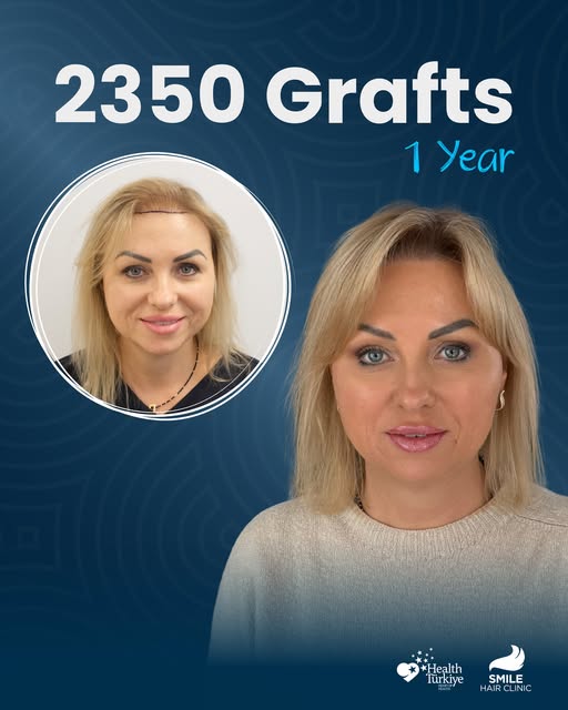 A natural hair transplant result designed around Katarzyna’s individual needs. ✨😍

By carefully pla