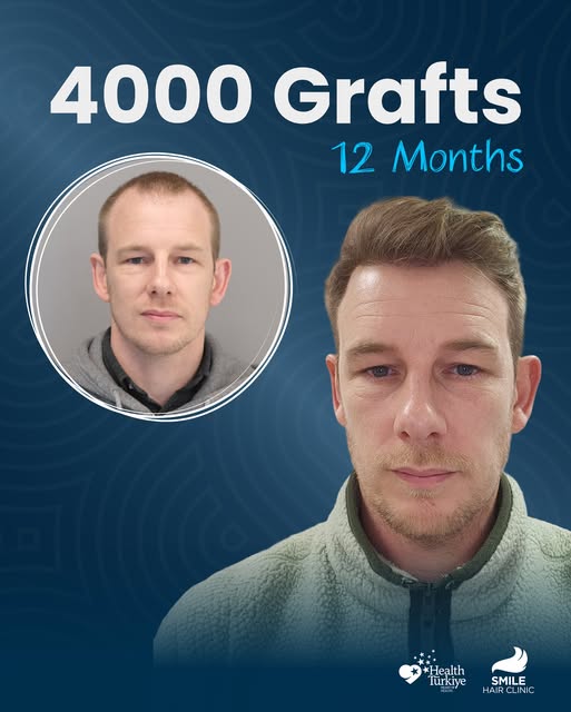 A year can change everything. 🔥

What started with 4000 carefully placed grafts has become a fuller
