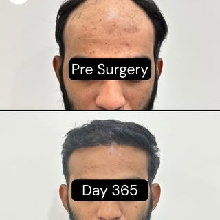 When you are watching your hairline recede, it can feel like you are fighting a losing battle, but y