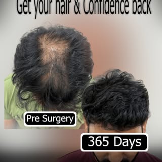 Restoring your hairline is about far more than just aesthetics, it is about reclaiming your self-ass