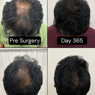 Swipe through to see what real precision looks like. Restoring your hairline is about far more than 