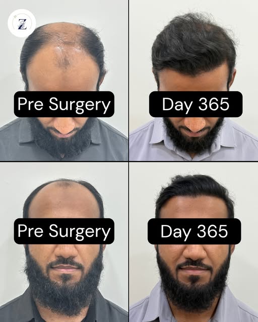 Restoring a full head of hair isn't just about appearance, it is about rebuilding your everyday conf