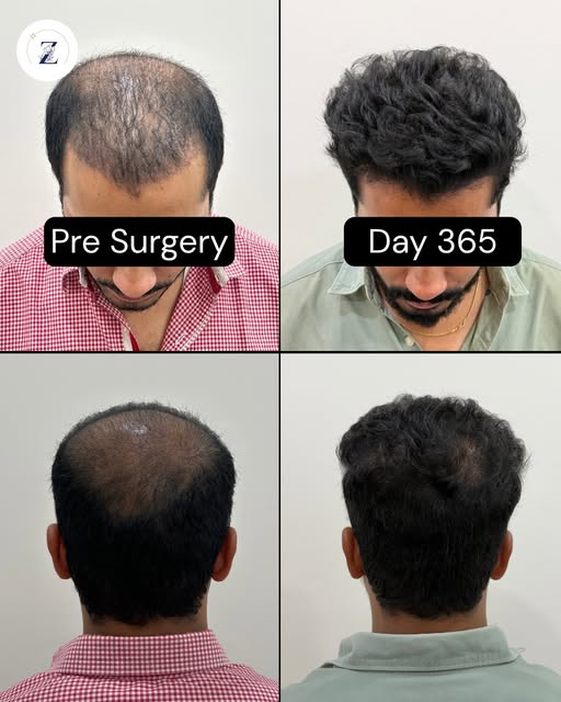 When thinning hair starts casting a shadow over your confidence, taking decisive action is the ultim