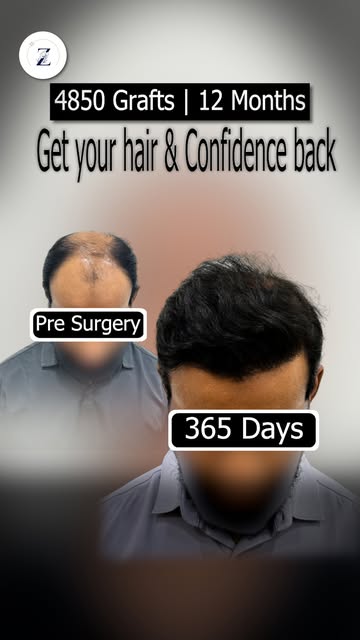 When hair loss takes a toll on your self-esteem, restoring full density right at the source can comp