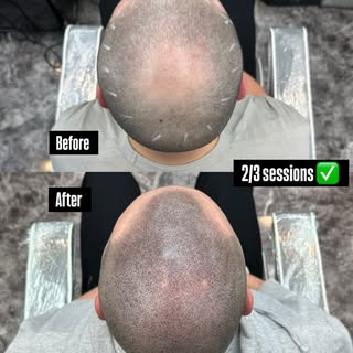 After just 2 sessions of scalpmicropigmentation the results are amazing. Can’t wait to see this fini