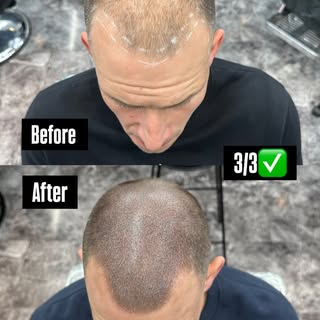 Full density treatment complete on this client! Get in touch for your free consultation DM for enqui