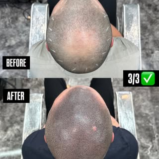 Real results from SMP Cheltenham … confidence restored, no surgery. Dm for your free consultation ✔️