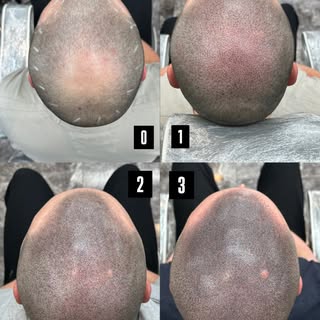The process of SMP! Game changer. 3 sessions. Real results. #smp #hairlosssolution #scalpmicropigmen