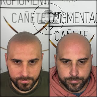 Micropigmentacion Capilar efecto rapado. 
Alcanzamos el máximo realismo y un efecto rapado súper nat