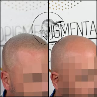 Hoy traemos un caso de micropigmentación capilar efecto rapado. Alcanzamos el máximo realismo y un e