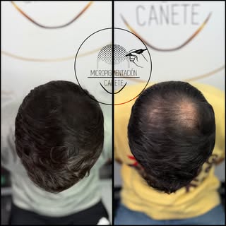 Traemos un caso de micropigmentación capilar en coronilla.
¿Cansado de utilizar fibra capilar?

En m
