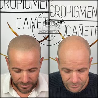 Micropigmentacion Capilar efecto rapado. Alcanzamos el máximo realismo y un efecto rapado súper natu