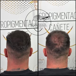 Coronilla totalmente cerrada gracias al trabajo de micropigmentación hecho. Con nuestra técnica de p