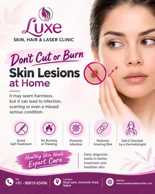 🚫 Don’t Cut or Burn Skin Lesions at Home!

That small skin growth, mole, wart, or lesion may not be