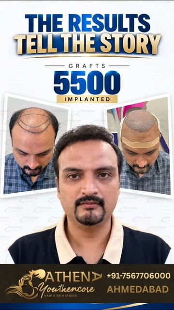 5500 GRAFTS. ONE CLINICAL OBJECTIVE: A NATURAL-LOOKING RESTORATION.
Real patient result from our hai