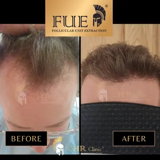 ✨️ Before ➡️ After | FUE Transformation ✨️ 

A restored hairline. Renewed confidence.

This client u