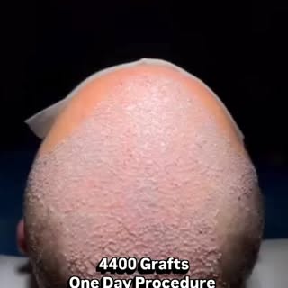 ✨️ Procedure Day | 4400 Grafts Sapphire FUE Technique 💎

Here's a look at the day of the procedure 