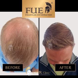 From thinning to thriving 🌱
The incredible transformation after 10 months following an FUE Sapphire