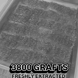 Freshly extracted grafts - precision in every follicle

Here's a close-up at the grafts just removed