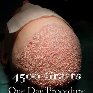 💥 4500 Grafts. One Day. Real, lasting results.
Experience the power of transformation with the FUE 