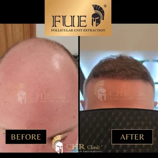 One Day. Real, lasting results.

Experience the power of transformation with the FUE Sapphire Techni