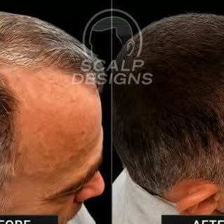 Grey Hair? SMP Can Make a Huge Difference.

Scalp Micropigmentation doesn’t change the color of your