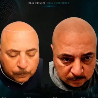 FROM BALD TO BOLD. 🔥

Scalp Micropigmentation can completely change the appearance of hair loss—wit