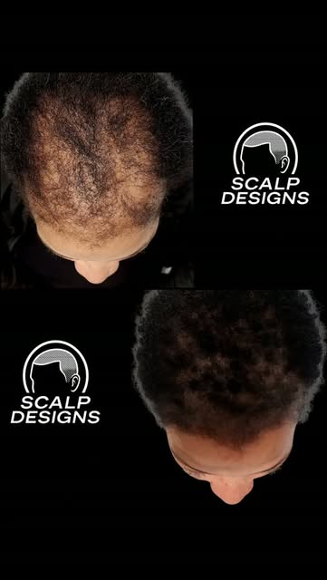 HAIR LOSS CAN LOOK DIFFERENT ON EVERY WOMAN. THE SOLUTION SHOULD TOO. ✨

This before & after shows h
