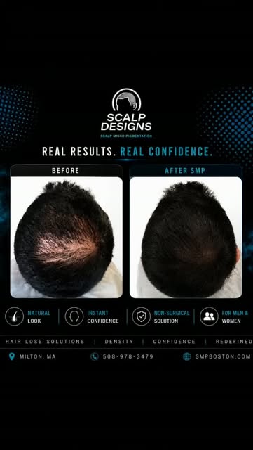 THINNING HAIR? SMP CAN CHANGE WHAT YOU SEE. 🔥
This before & after shows the power of Scalp Micropig
