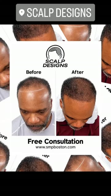 FROM THINNING TO A STRONGER, FULLER LOOK. 🔥
Scalp Micropigmentation can completely change the appea