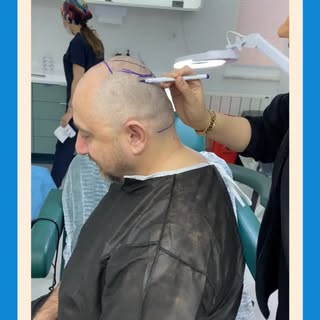 Saç ekiminde gerçek başarı, yüzünle uyumlu , doğal tasarlanmış bir saç çizgisinde gizlidir.