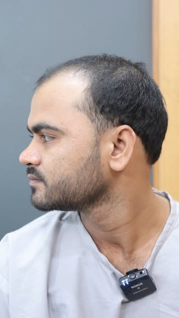Save this Reel & share it with someone considering a hair transplant.

[hair transplant transformati
