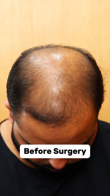Save this Reel and share it with someone considering a hair transplant.

[hair transplant after 9 mo