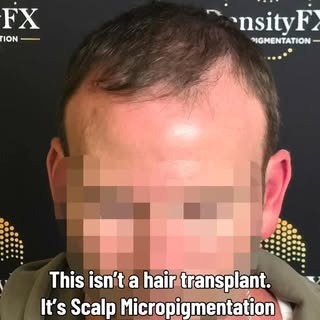 This isn’t a hair transplant.

It’s Scalp Micropigmentation.

For clients with long hair, SMP can he