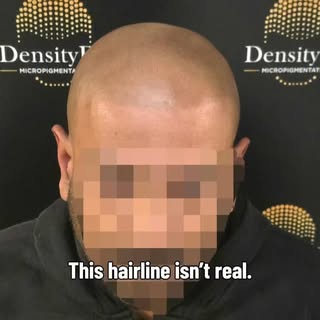 This hairline isn’t real.

It’s Scalp Micropigmentation. 👌

Designed to recreate the appearance of 