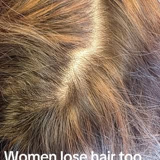 It’s not just for men. ❤️

If you’re tired of seeing more scalp than hair every time you look in the